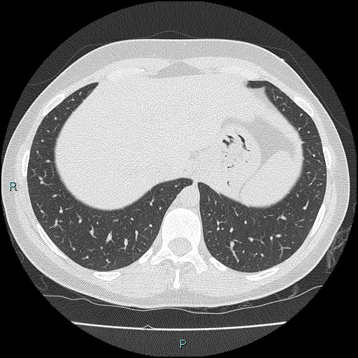 Accidental foreign body aspiration (seamstress needle) (Radiopaedia 77740-89983 Axial lung window 56).jpg