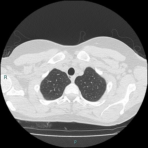 File:Accidental foreign body aspiration (seamstress needle) (Radiopaedia 77740-89983 Axial lung window 9).jpg