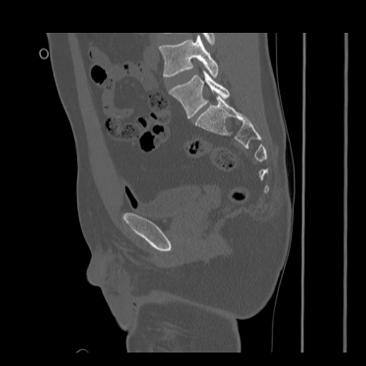 Acetabular and ilial fractures (Radiopaedia 59084-66378 Sagittal bone window 47).jpg