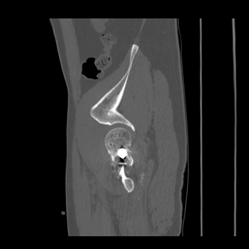 Acetabular and ilial fractures (Radiopaedia 59084-66378 Sagittal bone window 83).jpg