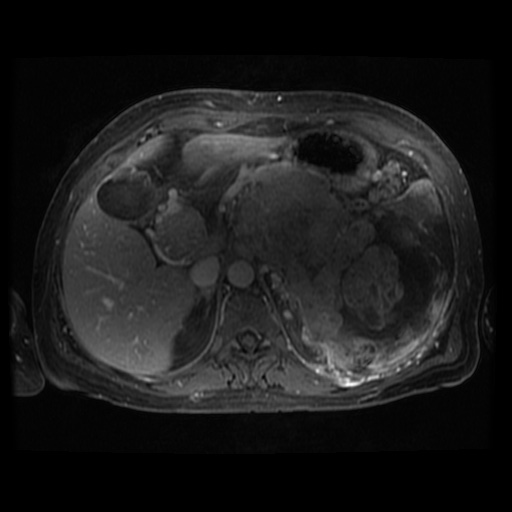 Acinar cell carcinoma of the pancreas (Radiopaedia 75442-86668 Axial T1 C+ fat sat 80).jpg