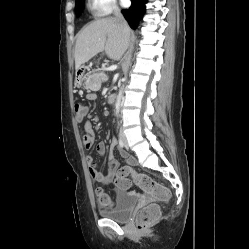 Acinar cell carcinoma of the pancreas (Radiopaedia 75442-86669 Sagittal C+ portal venous phase 92).jpg