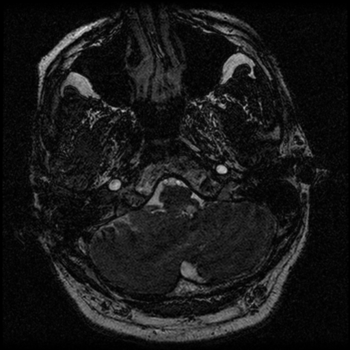 File:Acoustic schwannoma (Radiopaedia 39170-41387 Axial FIESTA 31).png