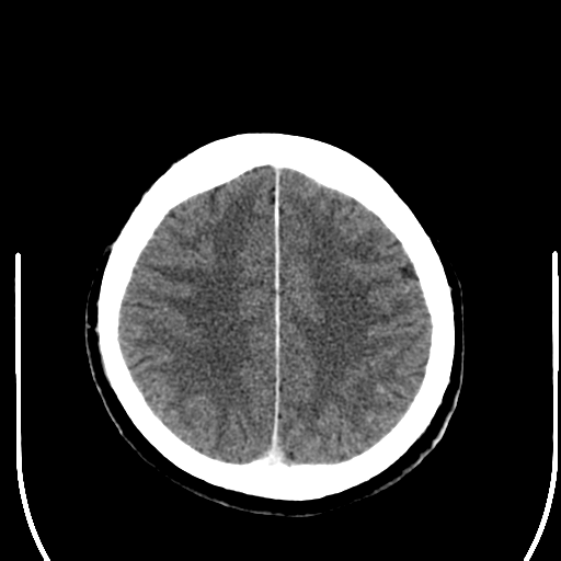 File:Acoustic schwannoma (Radiopaedia 39170-41389 Axial C+ 22).png