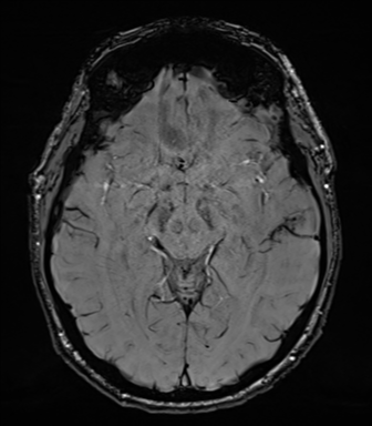 File:Acoustic schwannoma (Radiopaedia 50846-56358 Axial SWI 42).png