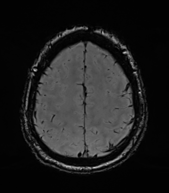 File:Acoustic schwannoma (Radiopaedia 50846-56358 Axial SWI 76).png