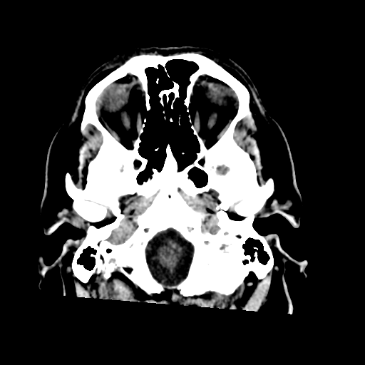 File:Acoustic schwannoma (Radiopaedia 55729-62280 Axial non-contrast 6).png