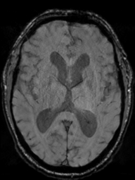 Acoustic schwannoma (Radiopaedia 55729-62281 Axial SWI 27).png