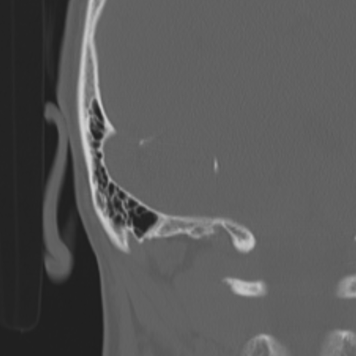 Acoustic schwannoma - eroding petrous apex (Radiopaedia 39674-42002 Coronal bone window 47).png