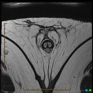 File:Acquired buried penis (Radiopaedia 39478-41797 Axial T2 27).jpg