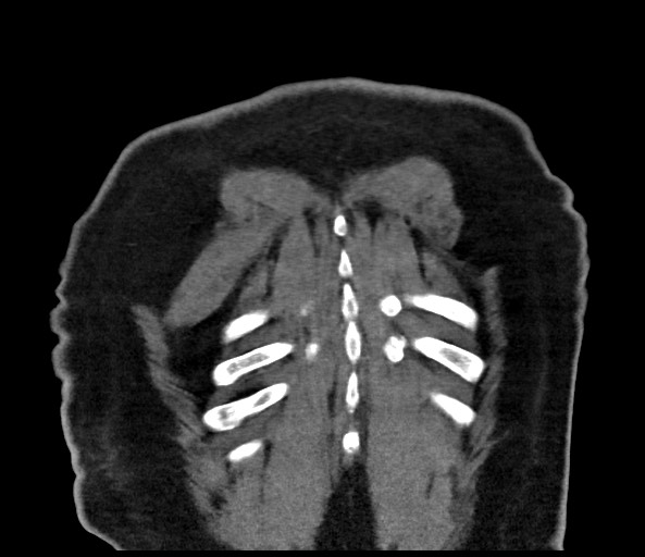 File:Acromioclavicular joint cyst (Radiopaedia 58455-65610 Coronal C+ arterial phase 131).jpg