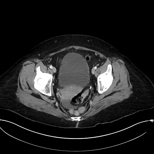 File:Active Crohn disease (Radiopaedia 59394-66750 Axial C+ portal venous phase 64).jpg