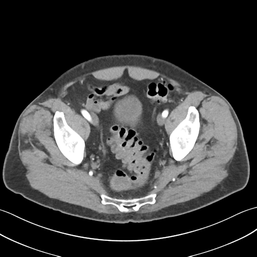 File:Active diverticular hemorrhage (Radiopaedia 39415-41725 Axial C+ arterial phase 59).png