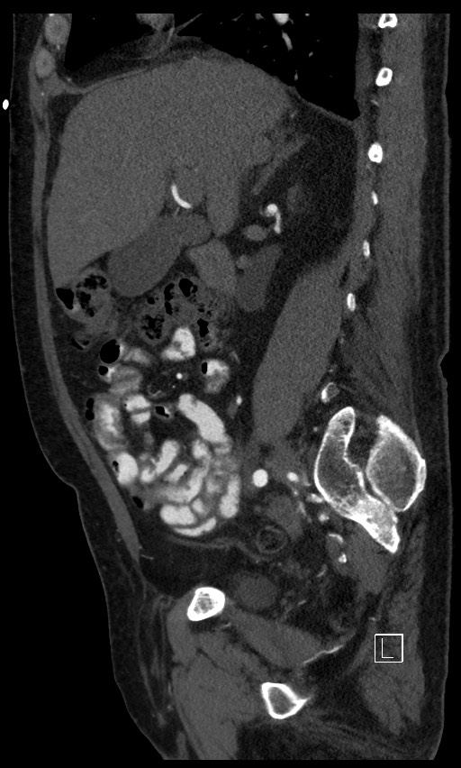Active lower gastrointestinal bleeding - diverticular (Radiopaedia 61203-69106 Sagittal C+ arterial phase 102).jpg