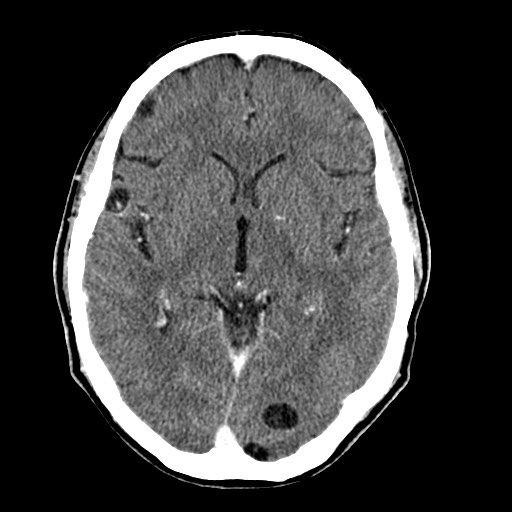 File:Active neurocysticercosis before and after therapy (Radiopaedia 71710-82099 Axial C+ delayed 55).jpg
