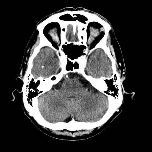 File:Active neurocysticercosis before and after therapy (Radiopaedia 71710-82099 Axial C+ delayed 79).jpg