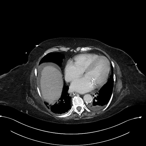 File:Active renal extravasation with large subcapsular and retroperitoneal hemorrhage (Radiopaedia 60975-68796 Axial 351).jpg