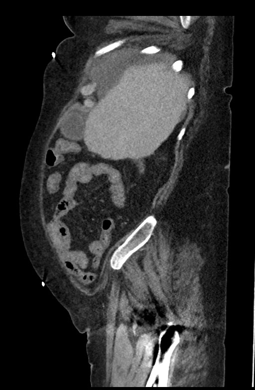 Active renal extravasation with large subcapsular and retroperitoneal hemorrhage (Radiopaedia 60975-68796 Sagittal C+ portal venous phase 178).jpg