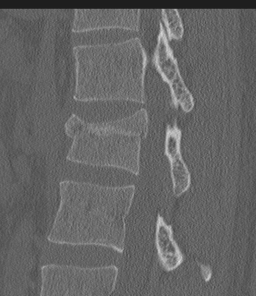 Acute L1 burst compression fracture (Radiopaedia 34430-35755 Sagittal bone window 38).png