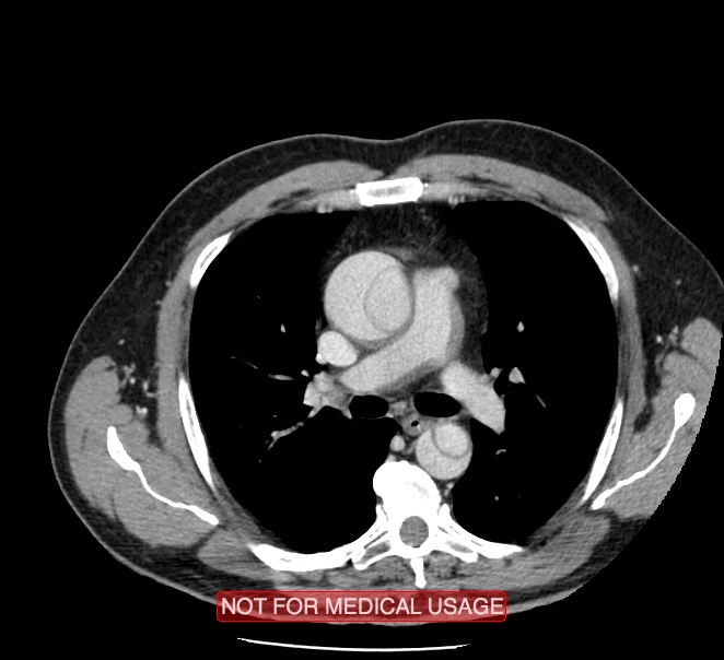 Acute aortic dissection - Stanford type A (Radiopaedia 40661-43285 Axial C+ portal venous phase 18).jpg
