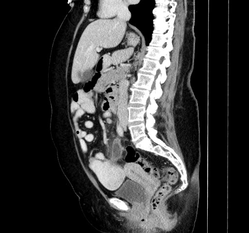 Acute appendicitis, heterotaxy syndrome (Radiopaedia 66884-76202 Sagittal C+ portal venous phase 66).jpg