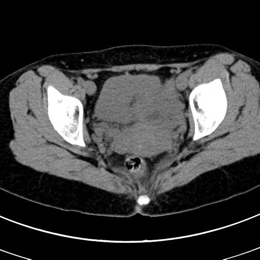 Acute appendicitis (Radiopaedia 30261-30888 Axial non-contrast 98).jpg
