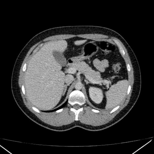 Acute appendicitis (Radiopaedia 38255-40270 Axial C+ portal venous phase 27).jpg