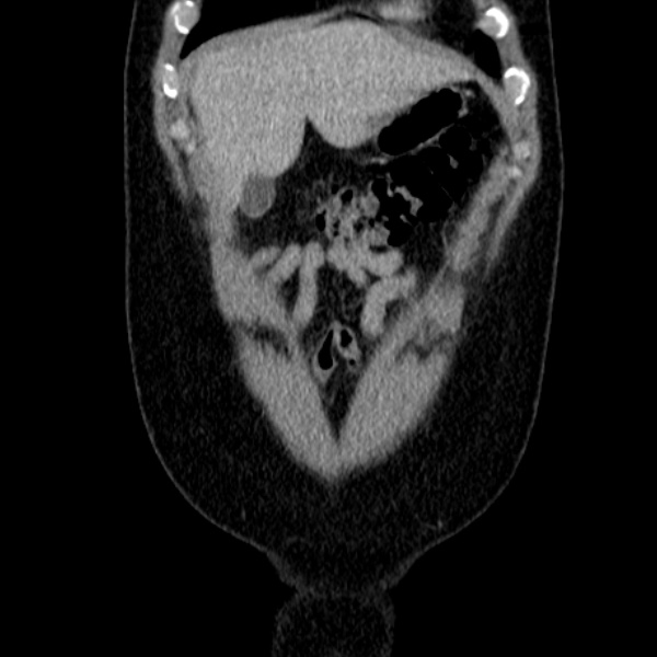 Acute appendicitis (Radiopaedia 38255-40270 Coronal C+ portal venous phase 17).jpg