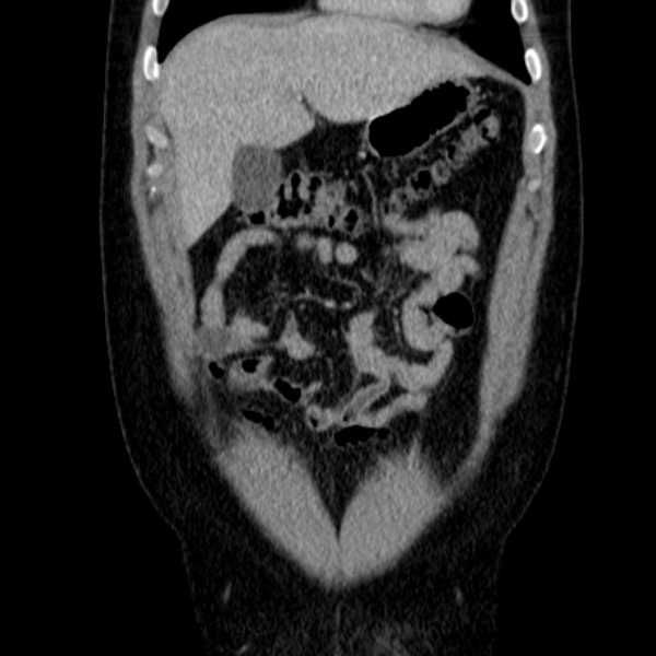 Acute appendicitis (Radiopaedia 38255-40270 Coronal C+ portal venous phase 23).jpg