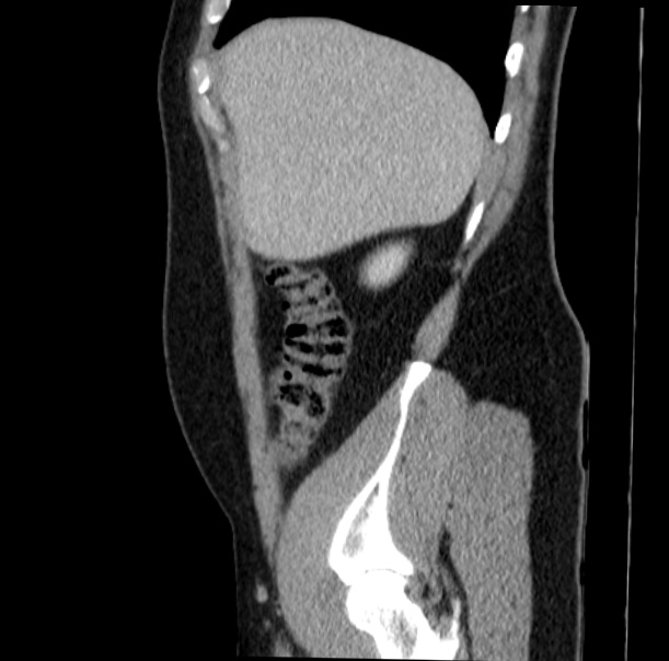 Acute appendicitis (Radiopaedia 38255-40270 Sagittal C+ portal venous phase 17).jpg