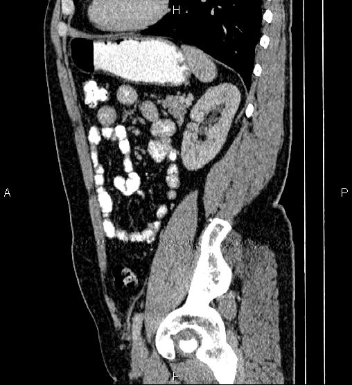 Acute appendicitis (Radiopaedia 84780-100240 Sagittal C+ portal venous phase 75).jpg