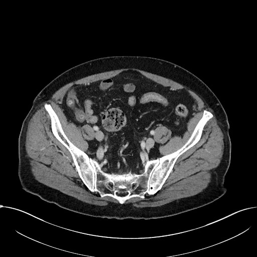 Acute appendicitis - large appendicoliths (Radiopaedia 61805-69820 Axial C+ portal venous phase 101).jpg