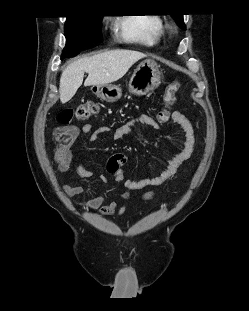 Acute appendicitis - large appendicoliths (Radiopaedia 61805-69820 Coronal C+ portal venous phase 36).jpg