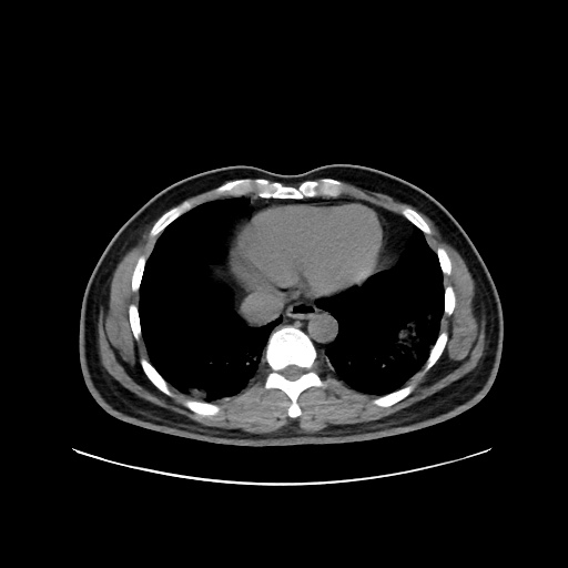 Acute appendicitis and COVID 19 pneumonia (Radiopaedia 76604-88380 Axial non-contrast 41).jpg