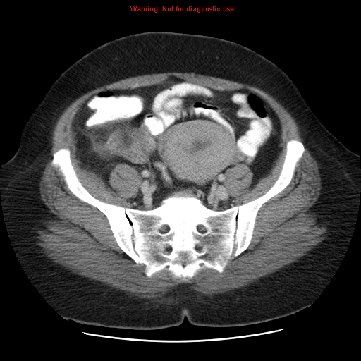 Acute appendicitis complicated by ovarian vein thrombophlebitis (Radiopaedia 16172-15851 Axial C+ portal venous phase 70).jpg