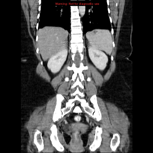 Acute appendicitis complicated by ovarian vein thrombophlebitis (Radiopaedia 16172-15851 Coronal C+ portal venous phase 60).jpg