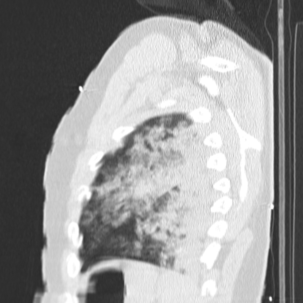 Acute aspiration pneumonitis (Radiopaedia 33605-34703 Sagittal lung window 74).jpg