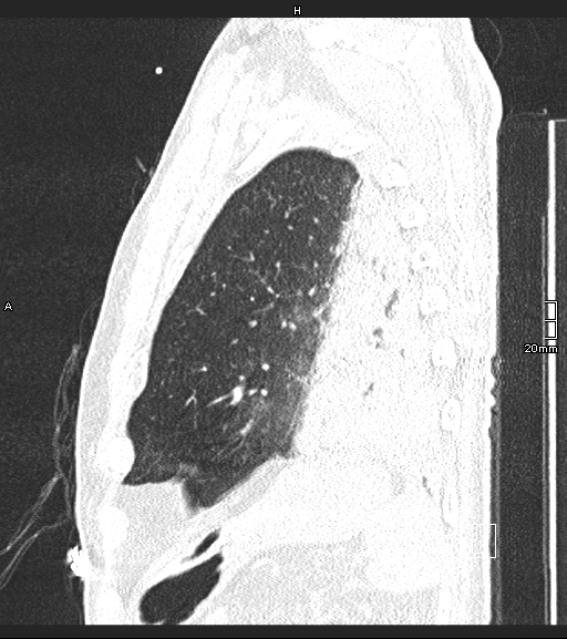 Acute aspiration pneumonitis (Radiopaedia 55642-62166 Sagittal lung window 20).jpg