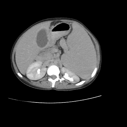 File:Acute calculous cholecystitis in patient with osteopetrosis (Radiopaedia 77871-90159 Axial C+ delayed 11).jpg