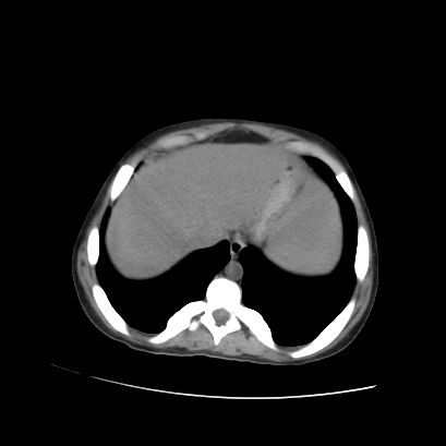 File:Acute calculous cholecystitis in patient with osteopetrosis (Radiopaedia 77871-90159 Axial non-contrast 16).jpg