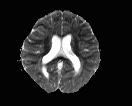 File:Acute cerebellar ataxia (Radiopaedia 61487-69446 Axial ADC 13).jpg