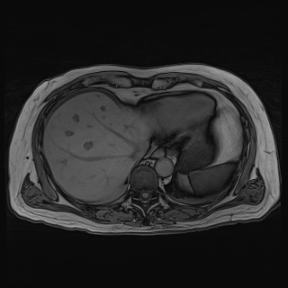 Acute cholecystitis (Radiopaedia 72392-82923 Axial T1 out-of-phase 27).jpg