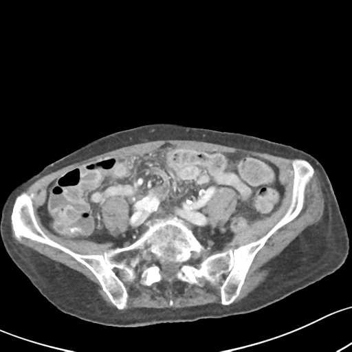Acute cholecystitis with contained perforation (Radiopaedia 47328-51907 Axial C+ portal venous phase 49).png