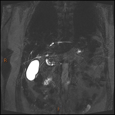 File:Acute cholecystitis with gallbladder neck calculus (Radiopaedia 42795-45971 Coronal Turbo spin echo 35).jpg