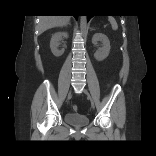 Acute cholecystitis with tensile fundus sign (Radiopaedia 71394-81723 Coronal non-contrast 77).jpg