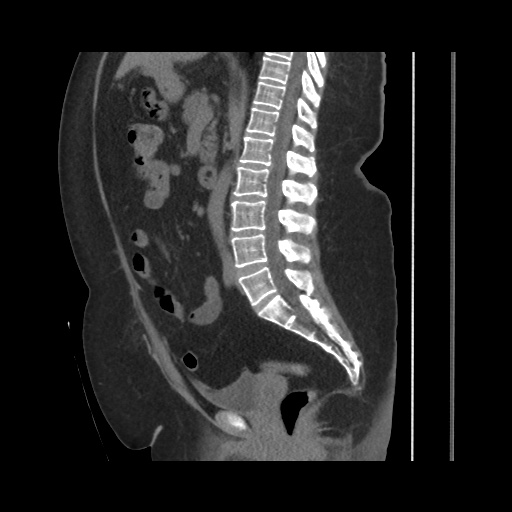 Acute cholecystitis with tensile fundus sign (Radiopaedia 71394-81723 Sagittal non-contrast 90).jpg