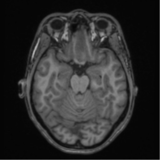 Acute disseminated encephalomyelitis (ADEM) (Radiopaedia 65319-74349 Axial T1 21).png