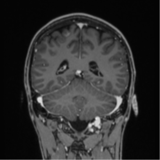 Acute disseminated encephalomyelitis (ADEM) (Radiopaedia 65319-74349 Coronal T1 C+ 8).png