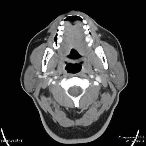 Acute epiglottitis (Radiopaedia 54375-60590 Axial C+ arterial phase 24).jpg