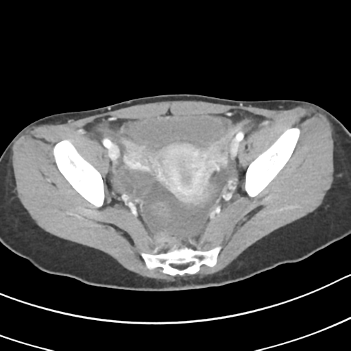 Acute gangrenous appendicitis with perforation (Radiopaedia 40152-42662 Axial C+ portal venous phase 63).png